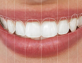Duy nhất: Miễn phí thiết kế nụ cười Digital Smile Design's photo